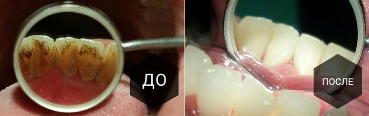 Пример удаления зубного камня
