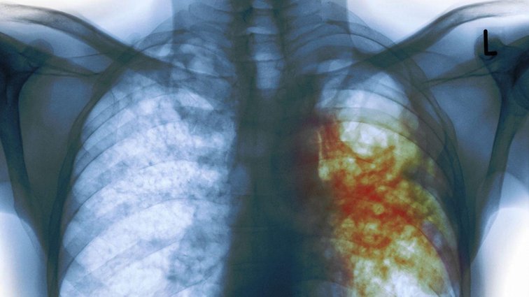 Правда и мифы о туберкулёзе