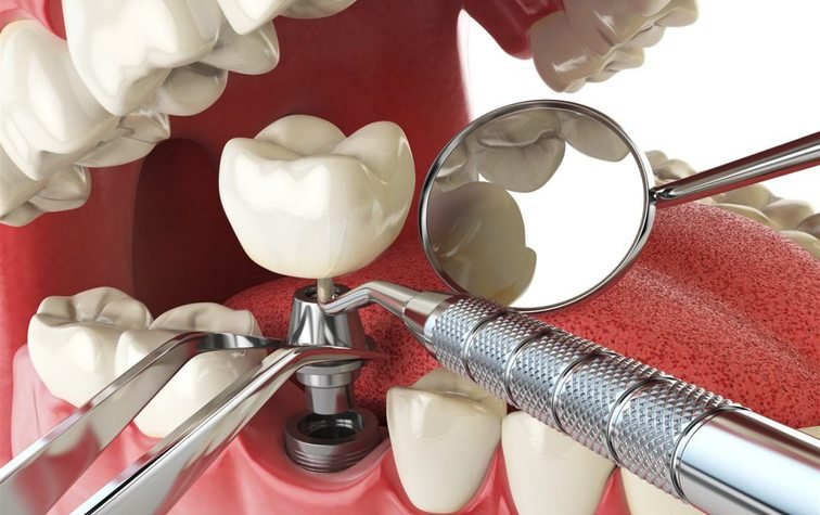 Как выбрать методику имплантации зубов
