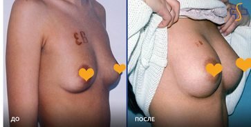 фото до и после операции по увеличению молочных желез