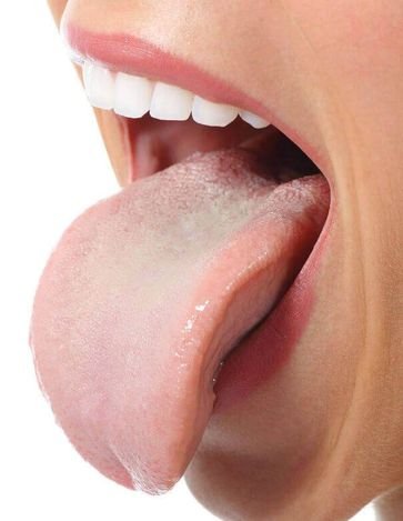 Лечение белого налёта на языке
