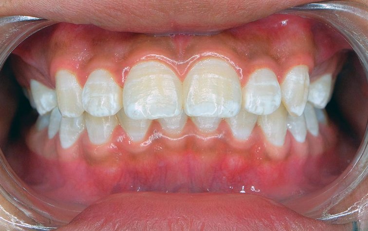 Лечение кариеса (пломбирования зубов) во Львове