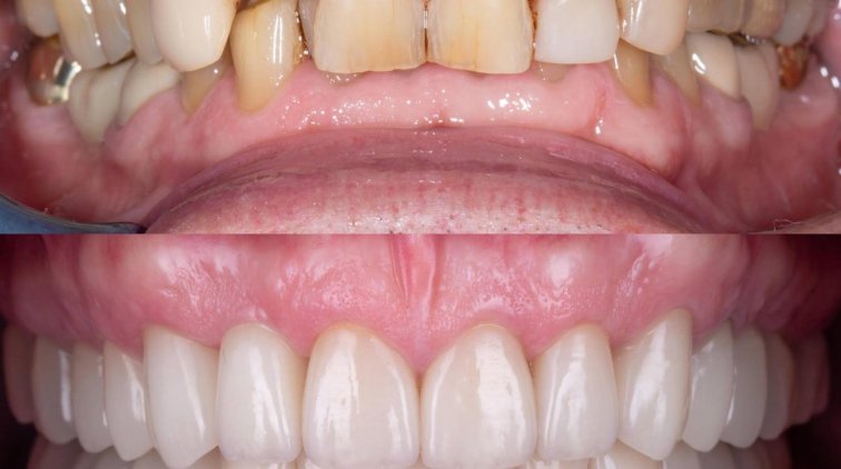 Имплантация зубов Днепр: цена на установку зубных имплантов